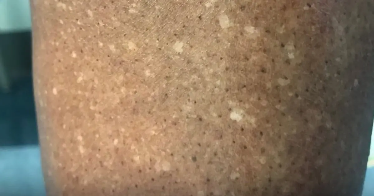 Doctors Explain Why White Spots Sometimes Appear on the Arms and Legs