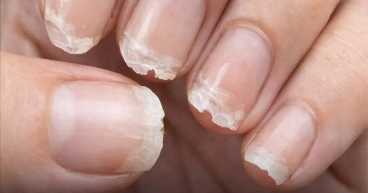 Weak or Brittle Nails: What Your Body Is Trying to Tell You