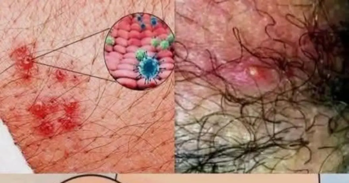 These Are the Signs of Genital Herpes Men Should Never Ignore: Symptoms, Causes, and When to Seek Medical Care
