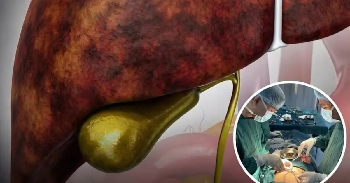 After Gallbladder Removal, Your Body Has to Adjust — Here’s What You May Notice in the Weeks Ahead…