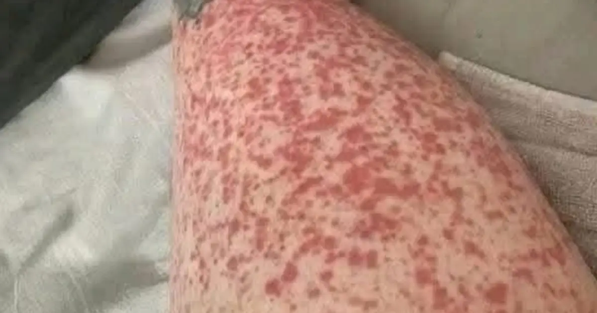 Skin Rashes After Intimacy: What They May Mean and When to Seek Medical Care