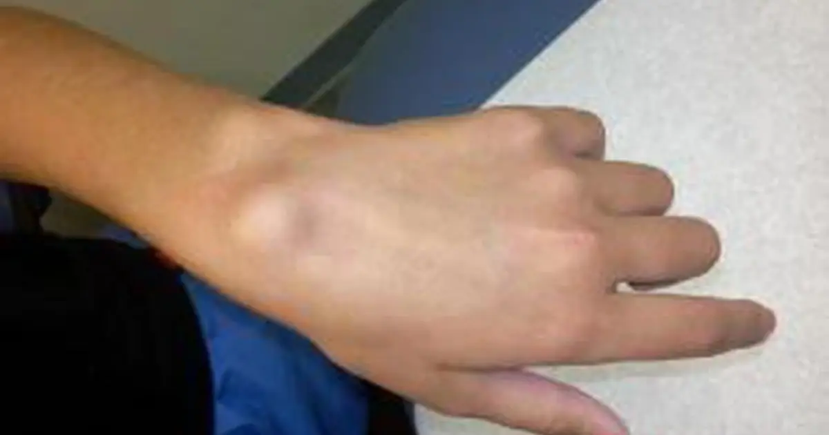 What Does a Lump on Your Hand Mean? Possible Causes Explained