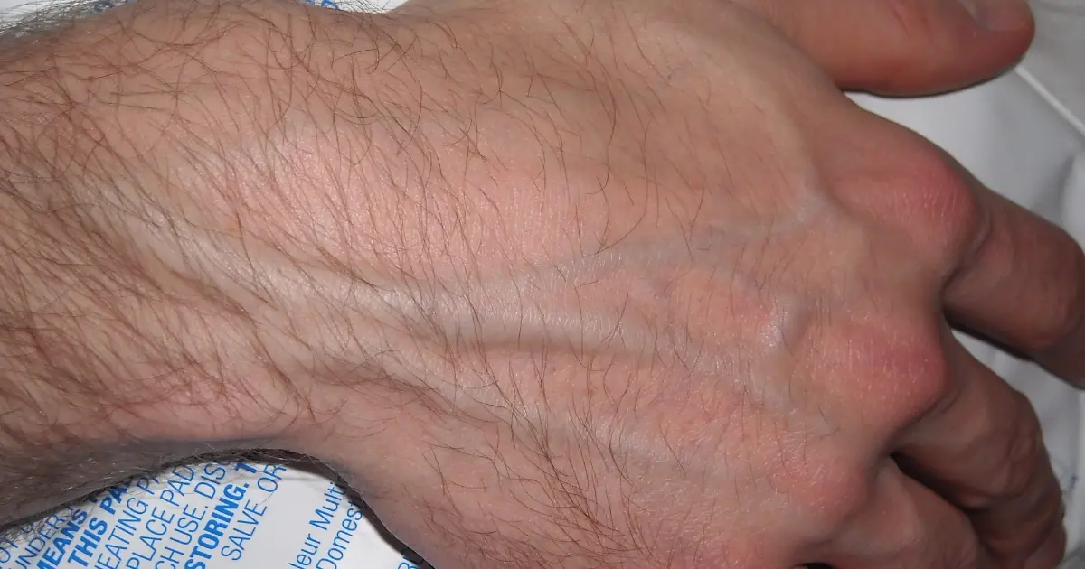 Visible Veins: What They Could Reveal About Your Health