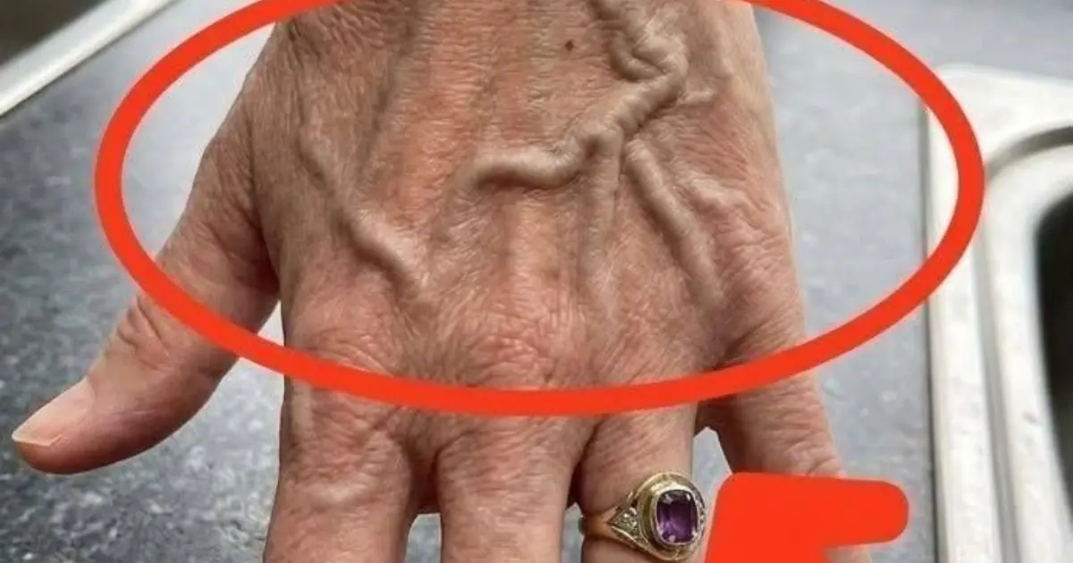 If your veins are visible in your hand, it is a signal of ca…See more