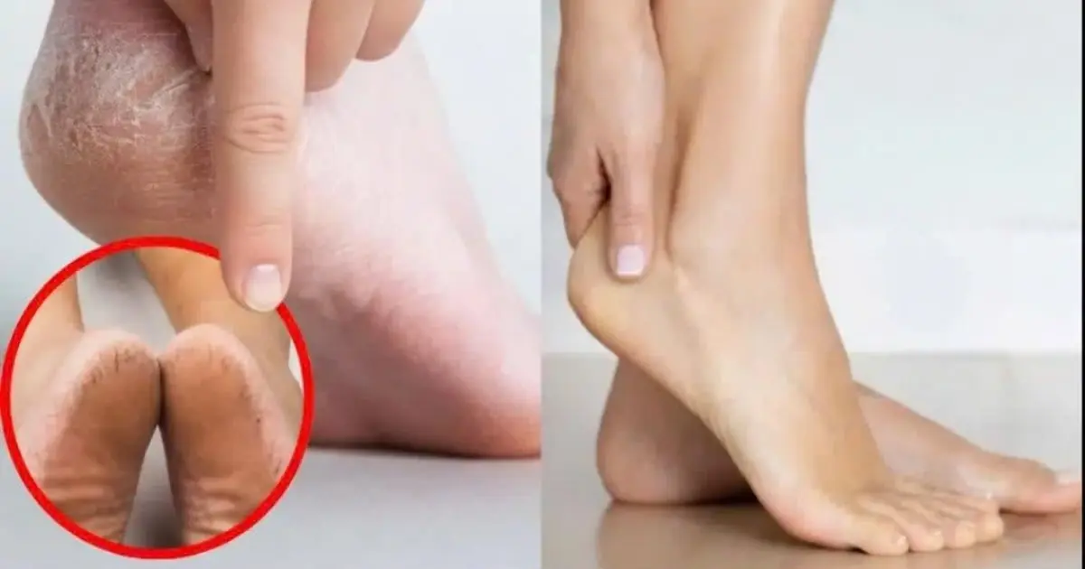 Cracked heels are not always caused by dry skin: Be aware of these conditions