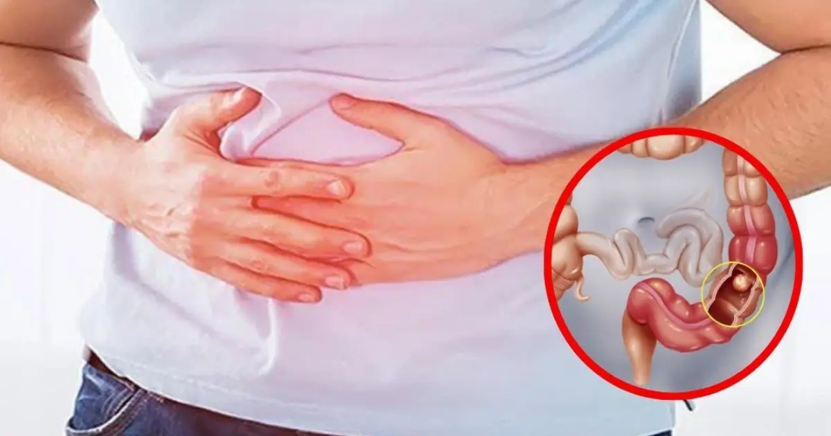 6 early warning signs of stage 1 colon can.cer you shouldn’t ignore