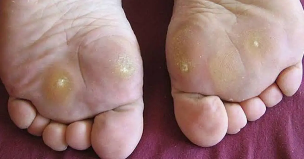 Can Your Feet Reveal Diabetes? Watch for These 5 Strange Symptoms