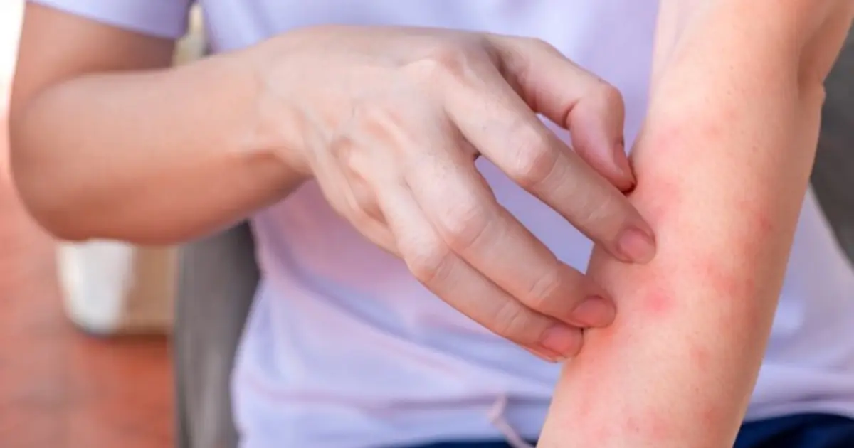 He Ignored the Itching, Thinking It Was an Allergy But the Real Diagnosis Shocked Him