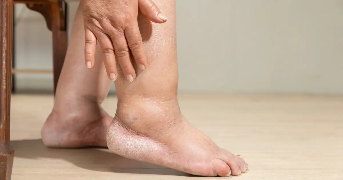 How to Reduce Swollen Feet Naturally: Simple Habits to Try Every Day