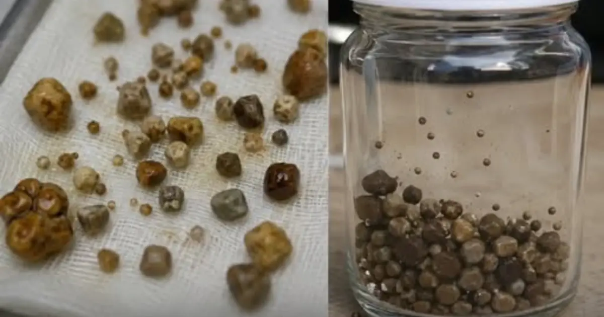9-Year-Old Boy Found With 56 Stones in His Abdomen — Doctor Reveals the Cause, Mother Breaks Down After