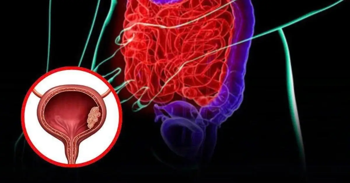 Bladder C.a.ncer: 5 Subtle Early Symptoms to Watch Out For