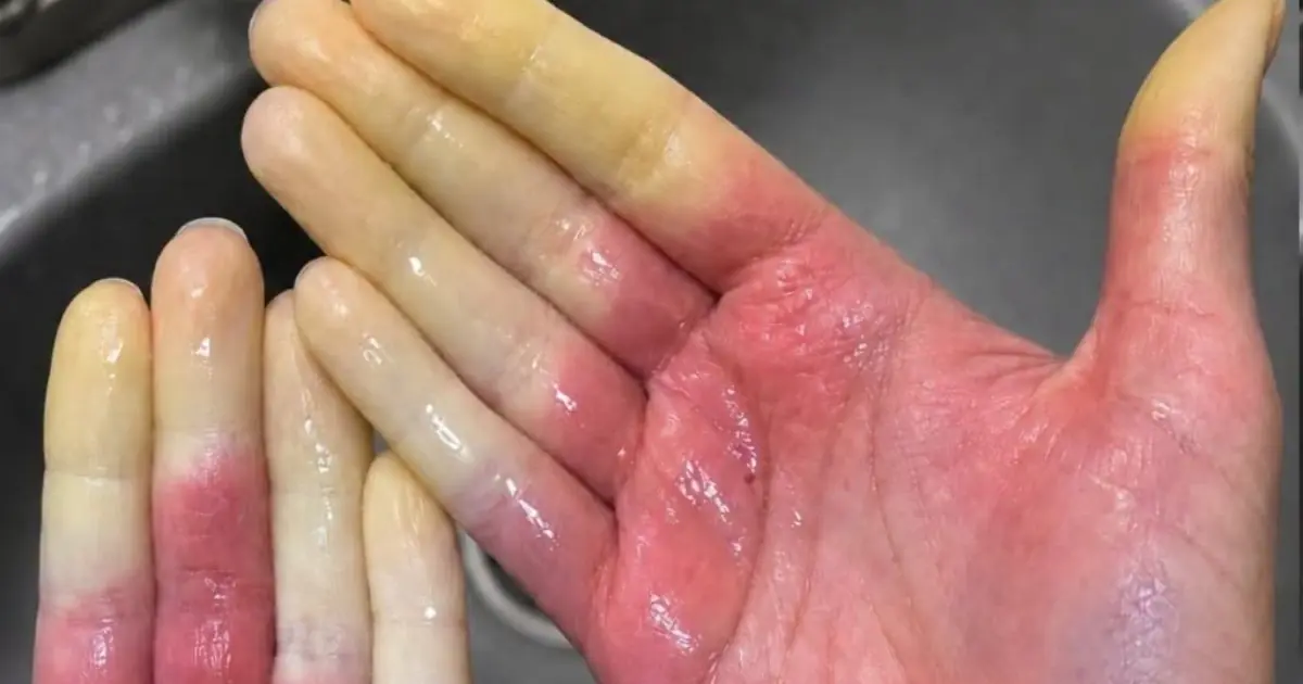 Why Do Fingers Turn White, Blue, and Red? The Warning Signs Explained