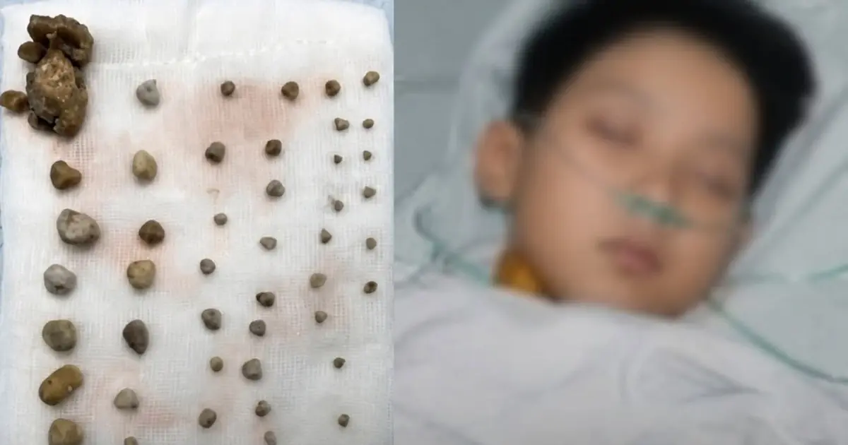 A 9-Year-Old Boy's Mysterious Stones: Why Children's Daily Habits Matter for Kid.ney and Urinary Health