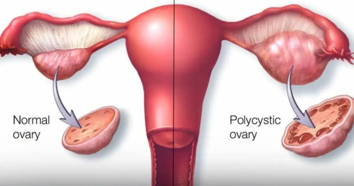 Eat 6 things to help women detoxify their ovaries and prevent gynecological diseases