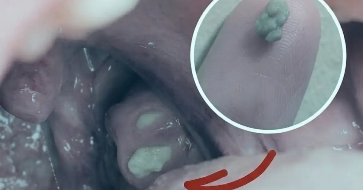 That Strange Feeling Like Something Is Stuck in Your Throat… Then a Small White Lump Suddenly Appears.