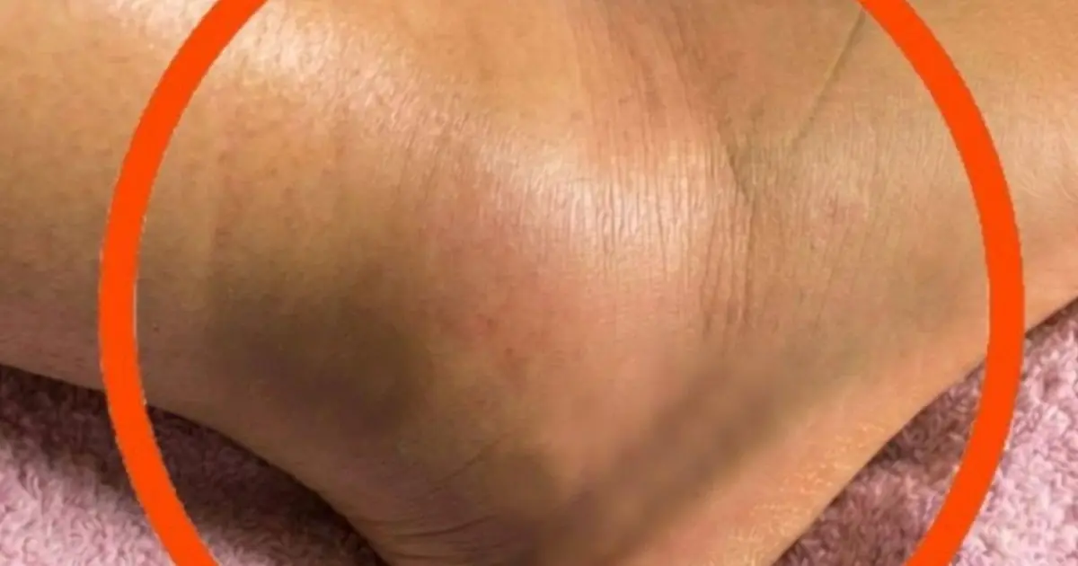 Swollen Legs: What Could It Mean? Common Causes You Should Never Ignore