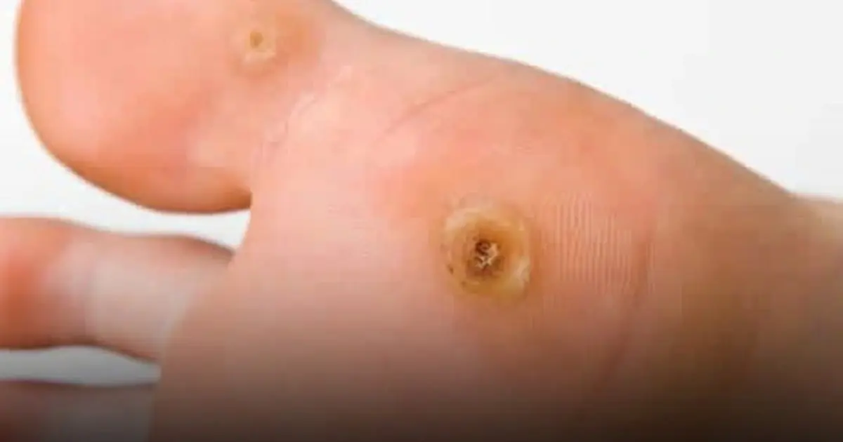 Stop Calling Them Calluses—“Fish Eyes” May Be a Viral Skin Condition