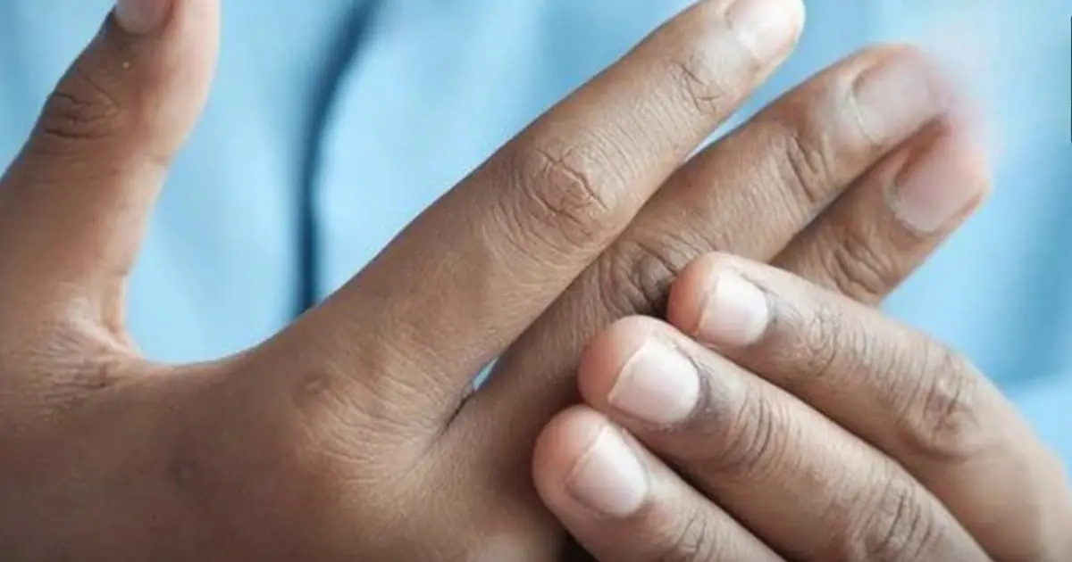 4 changes in fingers that could be signs of lung can.cer