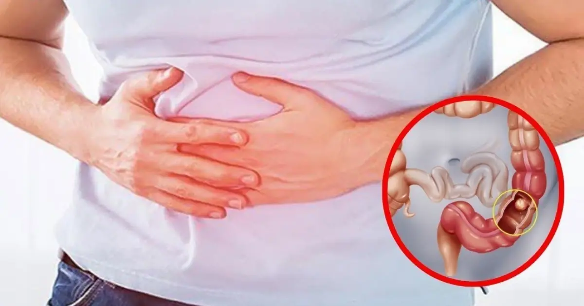 6 early warning signs of stage 1 colon can.cer you shouldn’t ignore