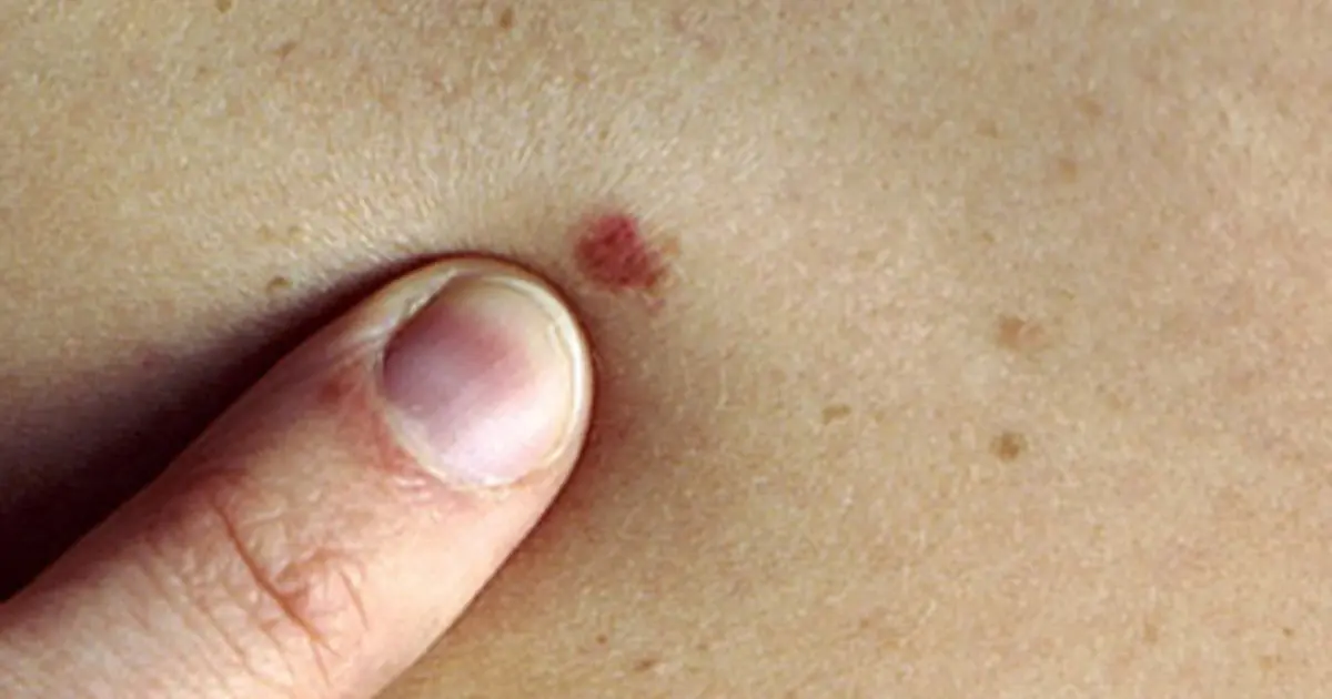 The Silent Can.cer Symptom That Can Easily Be Mistaken for a Common Infection