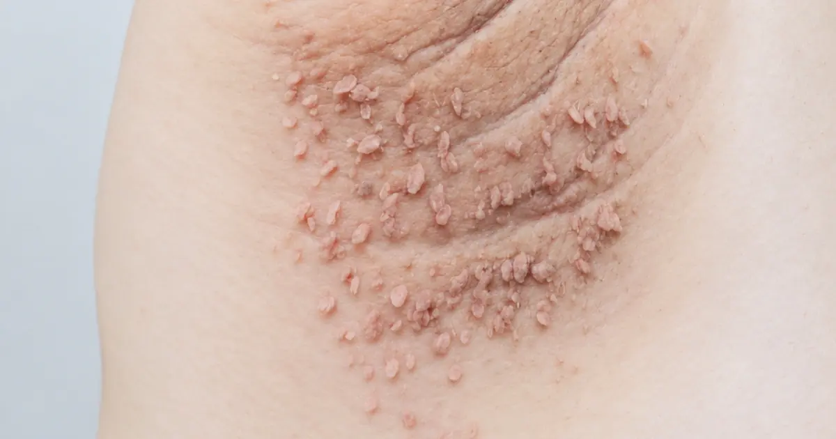 Why Are Certain Areas of Your Skin Turning Dark? Understanding the Signs of Acanthosis Nigricans