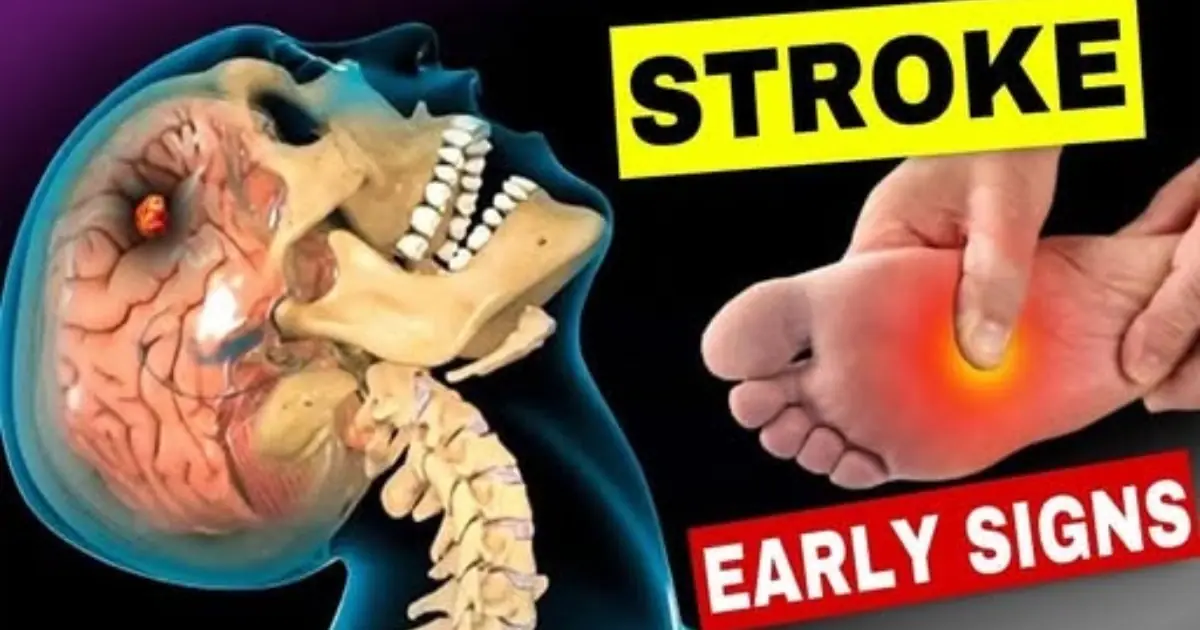 Recognizing early stroke warning signs may help save lives and prevent disability.