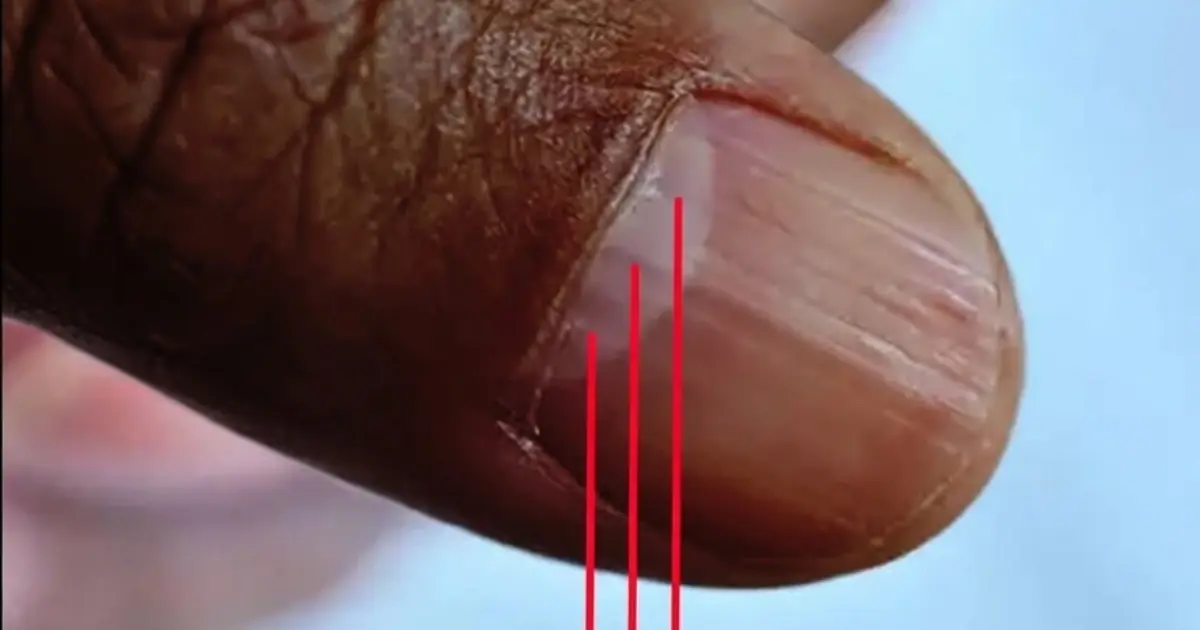 Lines on your nails may indicate nutritional deficiencies or other health issues