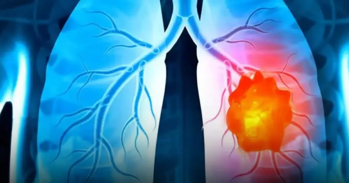 Your body may be sending signals — 9 early signs of lung cancer