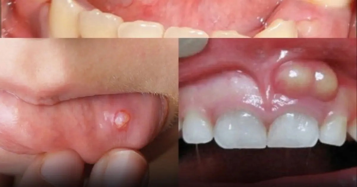 Hidden Dangers in Your Mouth: Early Signs of Oral Cancer