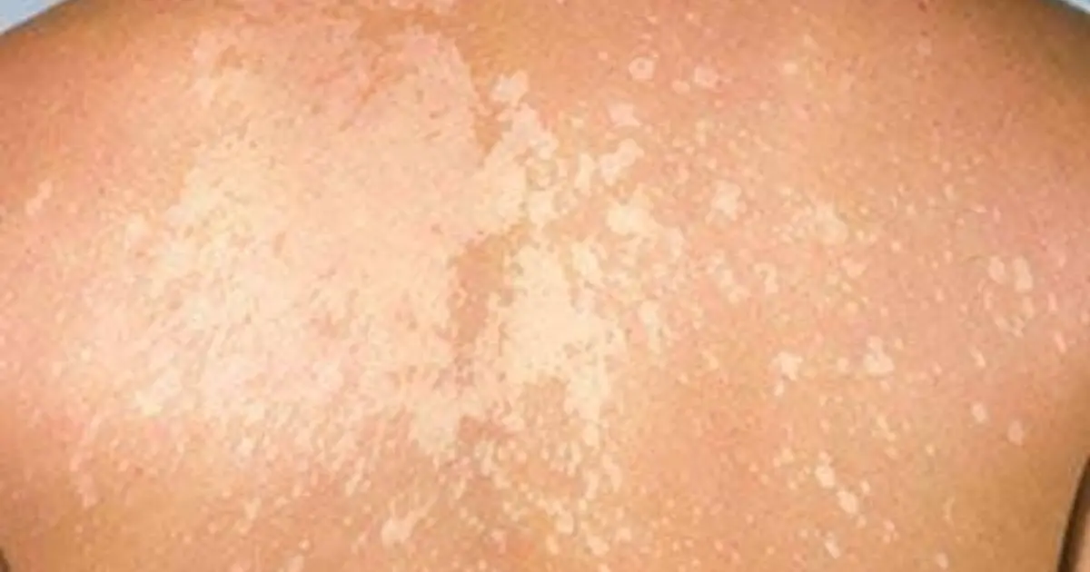 Why Are Small White Patches Appearing on Your Skin? The Possible Causes Explained