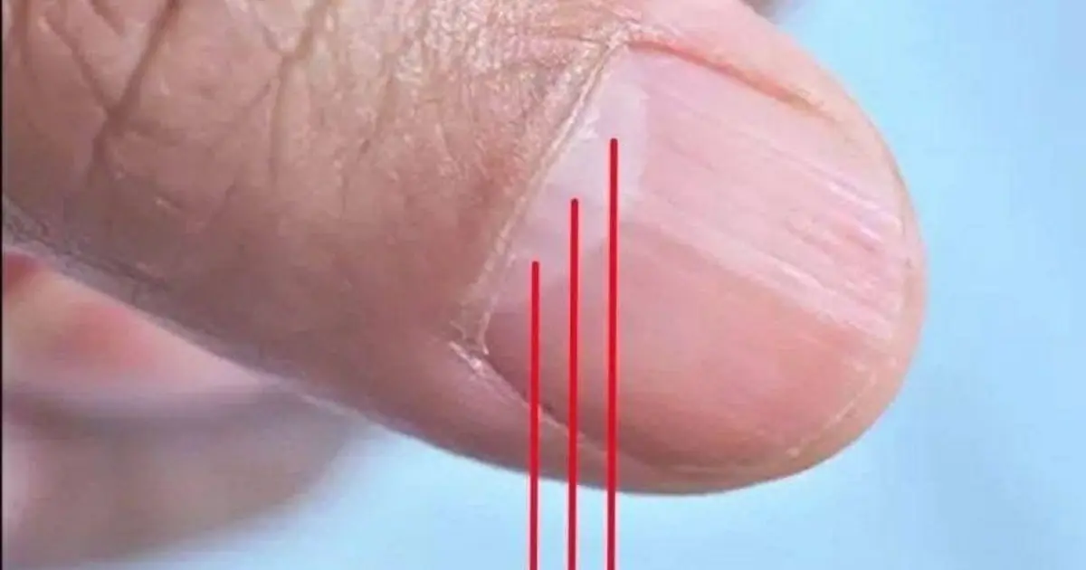 What Nail Lines Really Reveal About Your Health